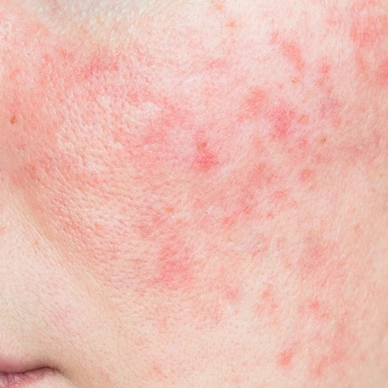 Acne